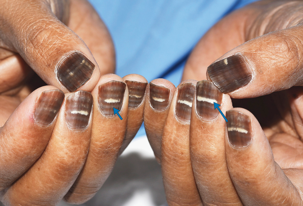 米氏线是由于指甲基质受损而产生,而muehrcke线则与异常的甲床血管